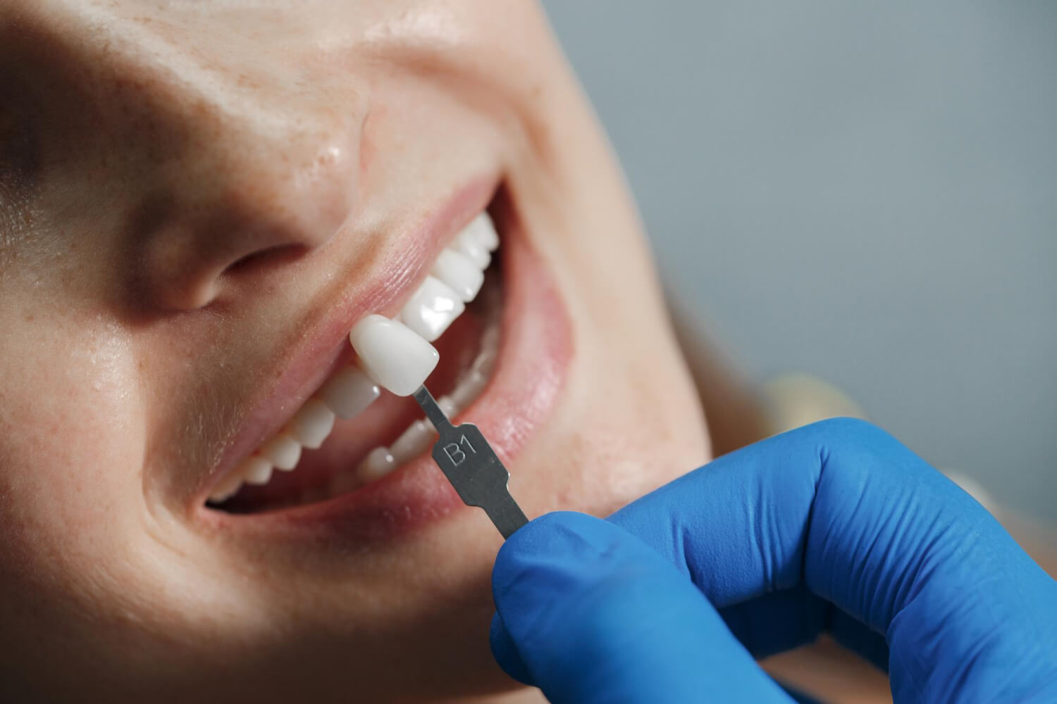 Dentista realizando seleção de cor com escala para restauração em resina composta de dente quebrado na Clínica Adachi em Santo André.